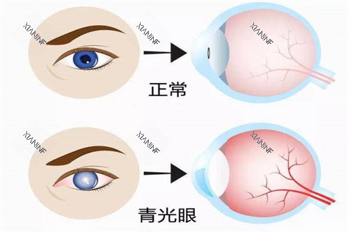 青光眼与正常眼睛对比图.jpg