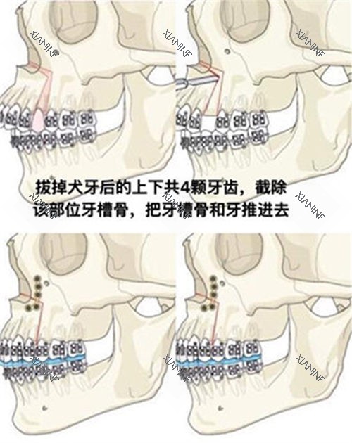 双鄂手术方式演示动画图.jpg