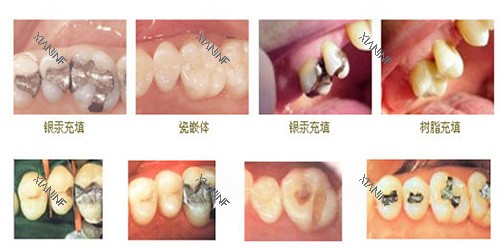 不同牙齿修补示意图.jpg