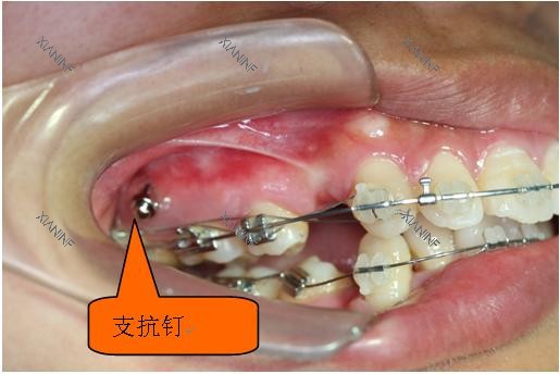 牙齿矫正骨钉种植钉口腔示意图.jpg