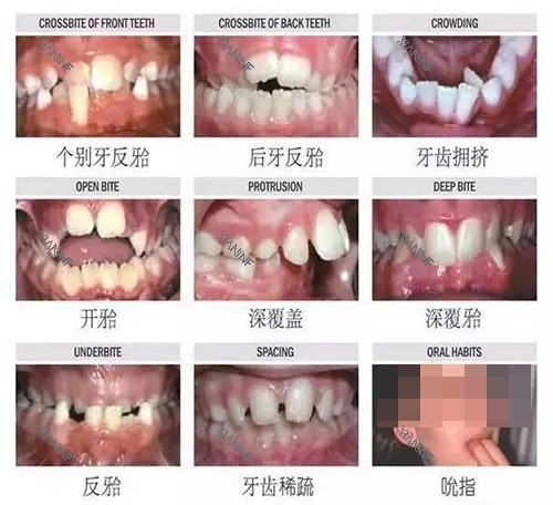 牙齿矫正不同类型的适应症.jpg