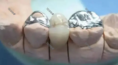镶牙治疗细节图.jpg
