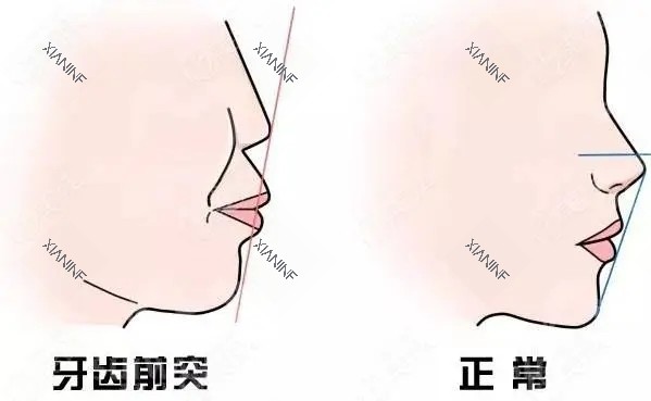 凸嘴.jpg