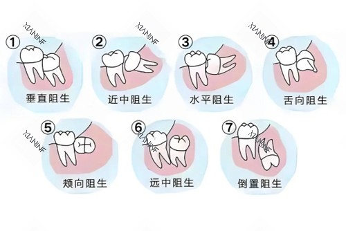 智齿难度系数图.jpg