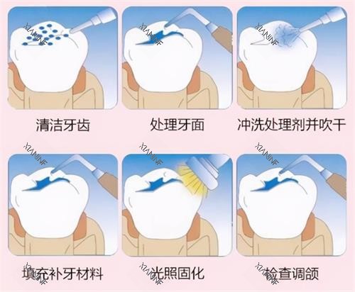 补牙的过程.png