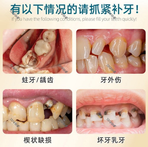 补牙适应症展示.jpg