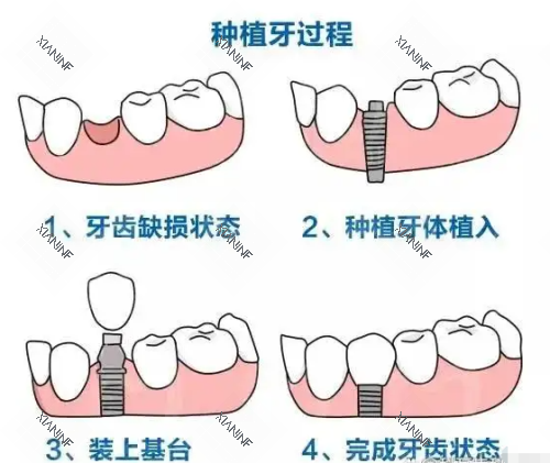 种植牙过程示意图.png