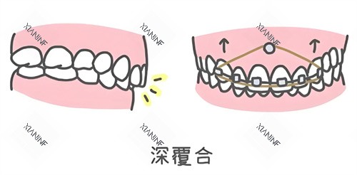 深覆合矫正.jpg