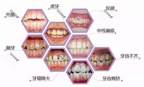 牙齿矫正适应症展示图.jpg