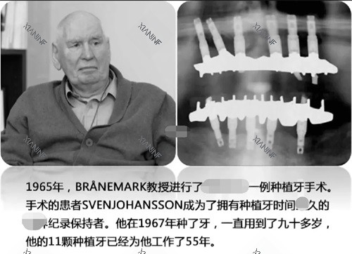 种植牙记录示意图.jpg