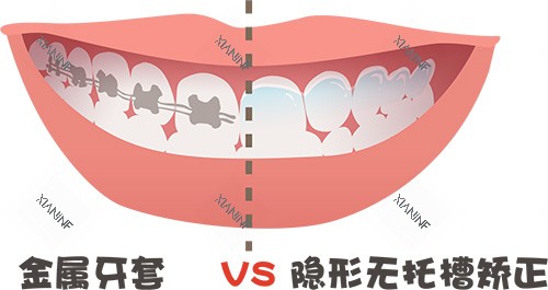 牙齿矫正牙套金属对比隐形牙套.jpg