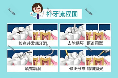 补牙流程图示.jpg