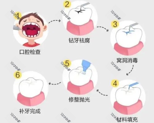 补牙具体步骤图.jpg