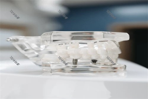 种植牙模型示意.jpg