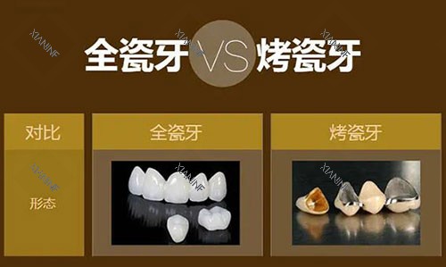 烤瓷牙和全瓷牙对比展示图.jpg