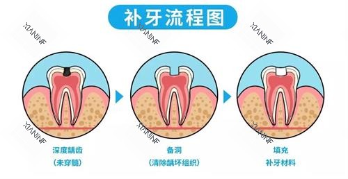 补牙的流程.png