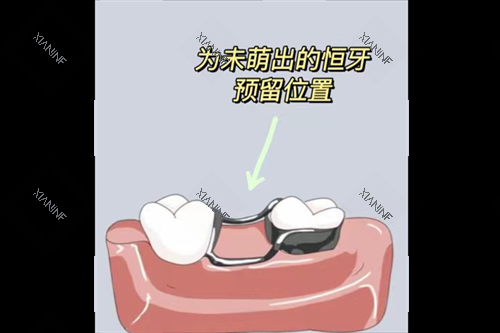 牙齿间隙保持器.png
