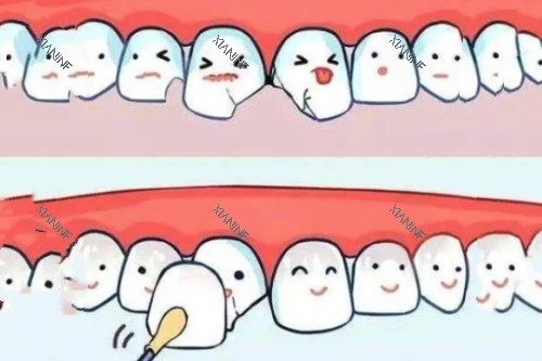 牙贴面卡通图.jpg