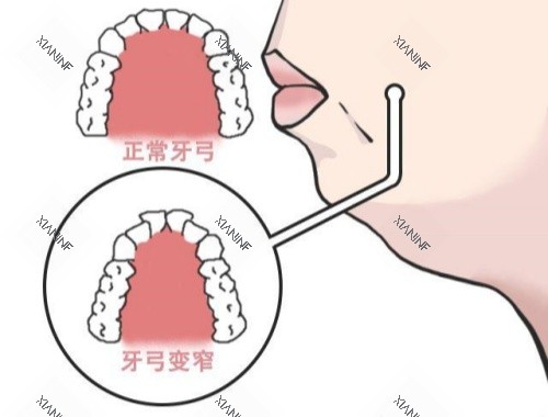 上牙弓狭窄卡通图.jpg