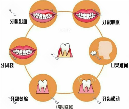牙周疾病照片.jpg