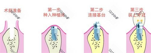 种植牙的步骤.jpg
