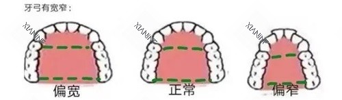 牙齿矫正牙弓形状.jpg