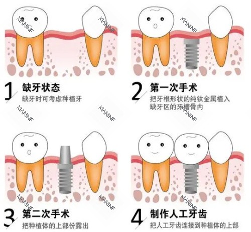 种植牙后的成效.jpg