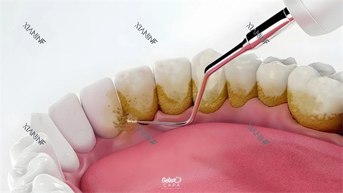 清洁牙结石.jpg
