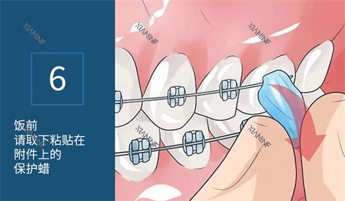 正畸保护蜡使用方法展示图.jpg