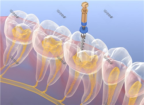 根管治疗透视图.jpg