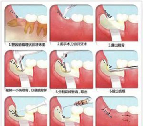 拔智齿过程示意图.jpg