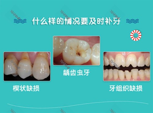 补牙适应症.jpg
