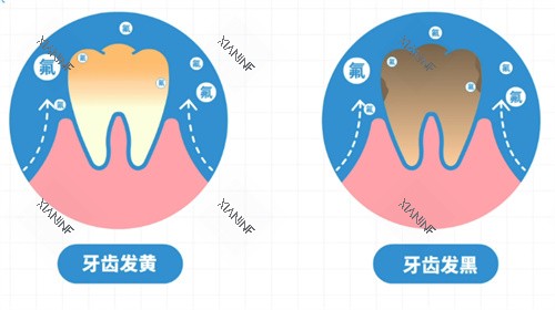 氟斑牙.jpg