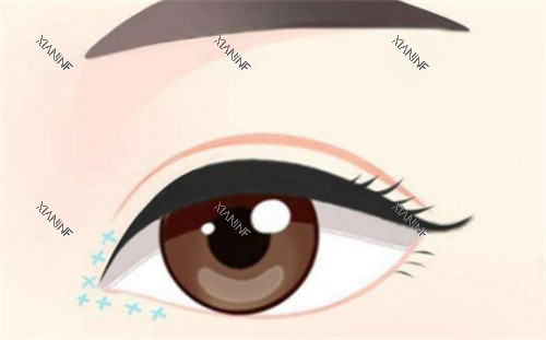 眼综合手术后眼部的样子.jpg 眼综合手术后眼部的样子.jpg