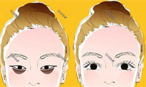 眼袋明显对比图.jpg 眼袋明显对比图.jpg