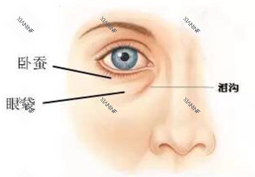 眼下卧蚕泪沟及眼袋对比示意图.jpg 眼下卧蚕泪沟及眼袋对比示意图.jpg