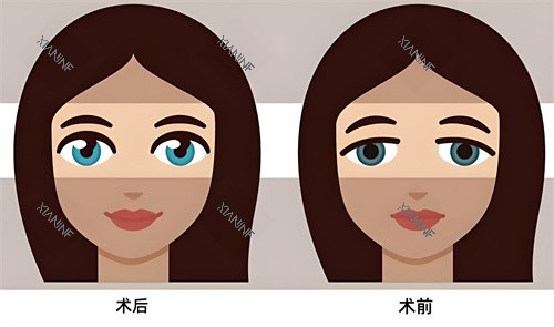 双眼皮术后术前对比动画图.jpg 双眼皮术后术前对比动画图.jpg