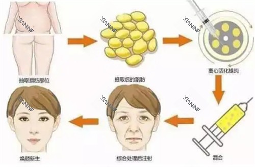 自体脂肪填充过程图解.jpg