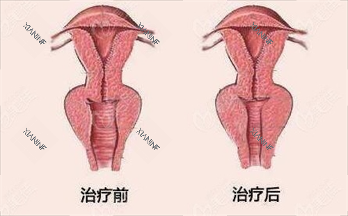 女性阴道紧缩手术前后对比动画图.png