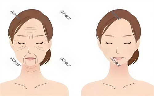 眼袋手术前后对动画图.jpg 眼袋手术前后对动画图.jpg