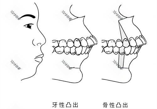 牙性突出和骨性突出对比图.jpg 牙性突出和骨性突出对比图.jpg