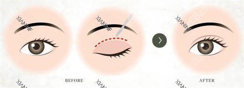双眼皮术对比宣传图.jpg 双眼皮术对比宣传图.jpg