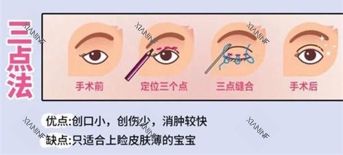 双眼皮手术三点法动画演示图.jpg 双眼皮手术三点法动画演示图.jpg