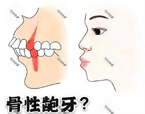 骨性龅牙和齿性龅牙.jpg 骨性龅牙和齿性龅牙.jpg