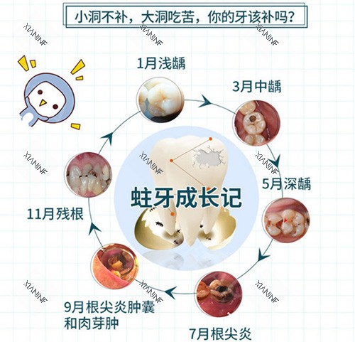 蛀牙发展过程.jpg