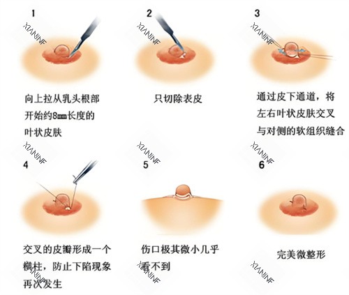 乳头内陷矫正手术过程.jpg 乳头内陷矫正手术过程.jpg
