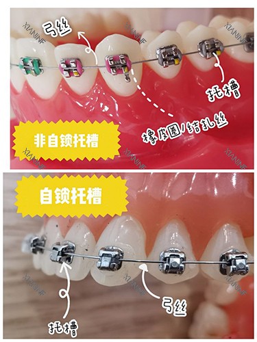 牙齿矫正自锁和非自锁牙套区别.jpg