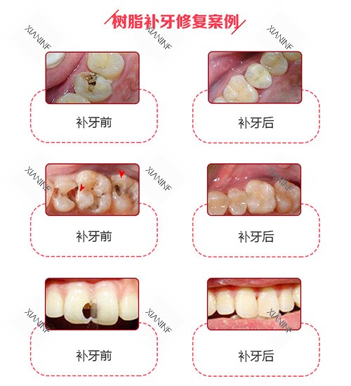 树脂补牙修复实例.jpg