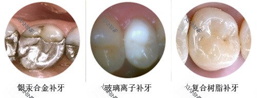 补牙材料示意图.jpg