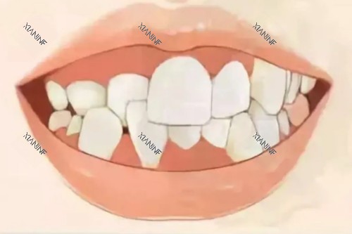 牙齿畸形卡通模型图.jpg